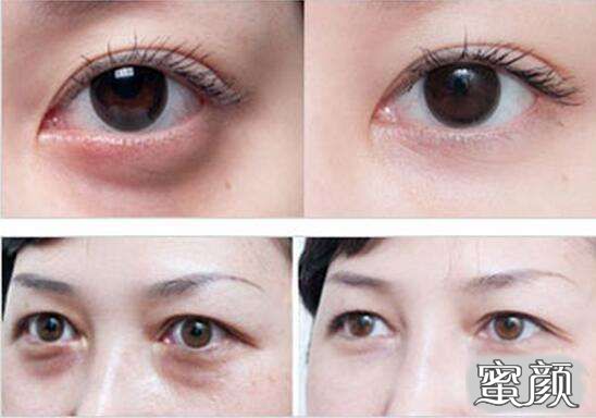 科技揭秘，最新去眼袋最佳方法，重塑眼部美麗新篇章！