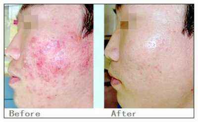 激光祛疤價(jià)格詳解，深度解析與觀點(diǎn)闡述