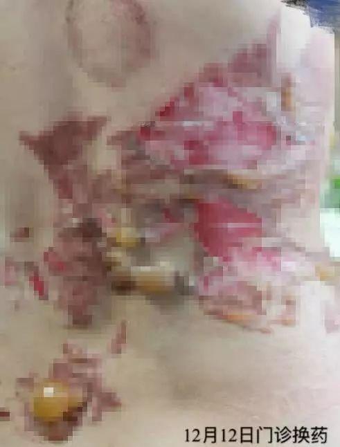 小巷特色養(yǎng)生館，最新拔罐圖片分享